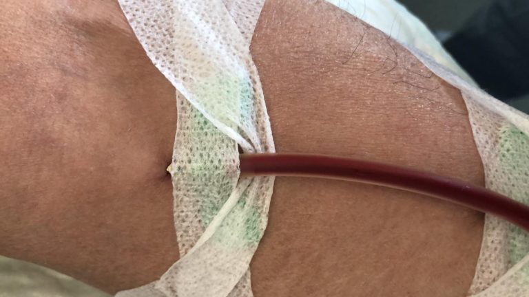 Il ruolo dell’infermiere nella tecnica buttonhole